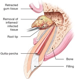 root canal