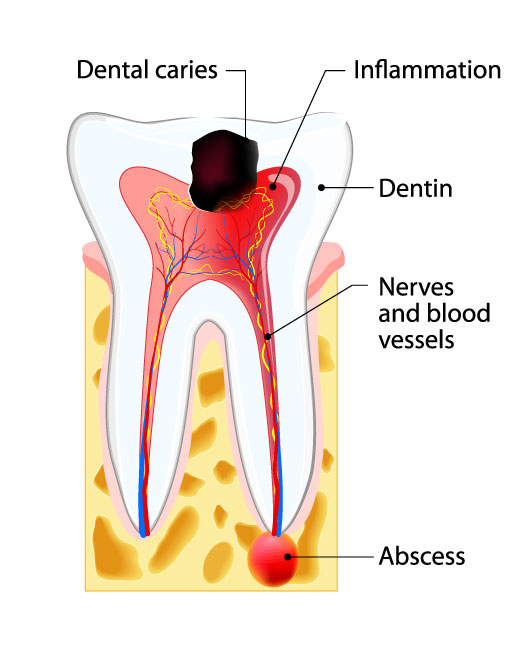 root canal