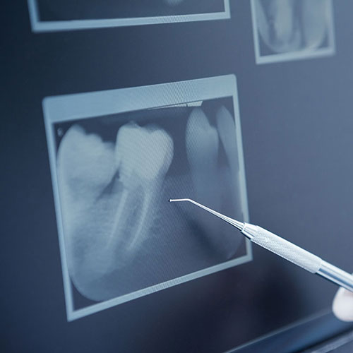 xray of cracked tooth