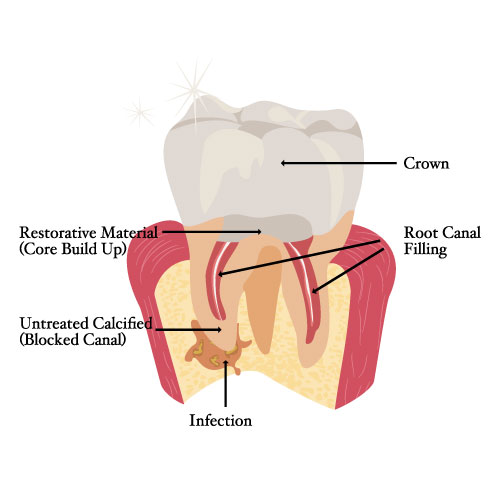 Root Canal Retreatment